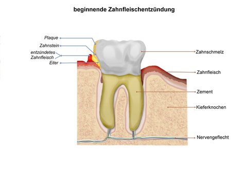 zahnfleischentz&uuml;ndung