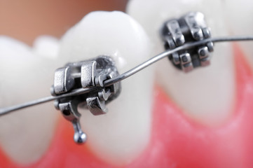 Dental braces super macro ,crooked teeth ,shallow depth of field