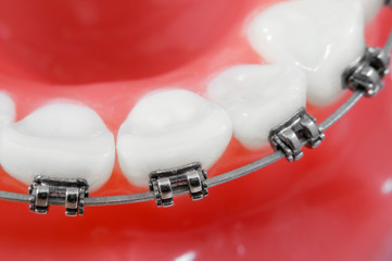 Dental braces super macro ,  shallow depth of field