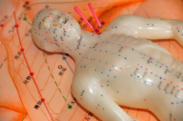 Acupuncture