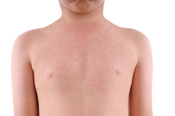 Close up image of a little boy’s body suffering urticaria. - obrazy, fototapety, plakaty