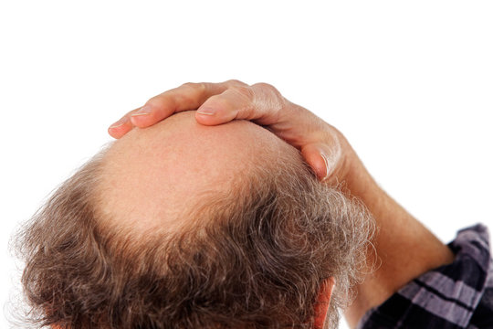 hand on bald head