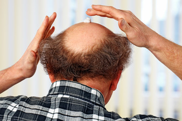 cream on the bald head