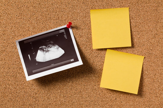 ultrasound photo on corkboard