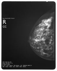 Healthy breast scan X-ray plate.