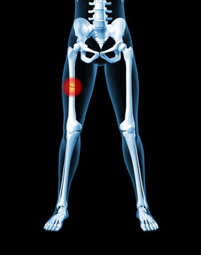 Female skeleton with broken leg bone