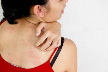 Ethic young woman back with itchy skin