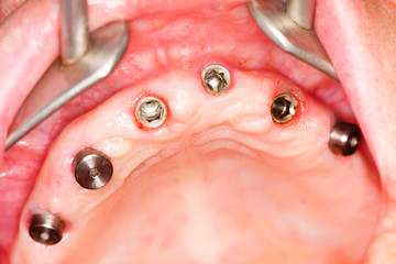 Dental implants - gingival cuffs