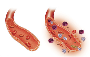 Inflamación arterial