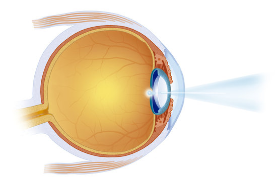 intervención de retina con el láser