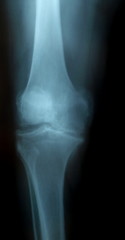 x-ray Osteoporosis