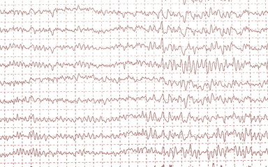 electroencephalogramme (EEG)