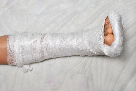Аллергия на гипс при переломе как выглядит Afbeeldingen over "Broken Leg" - Blader in stockfoto's, vectoren en video's over