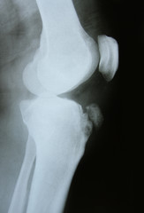 x-ray image of the bones of leg