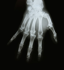 x-ray image of the bones of arm