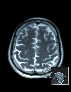 magnetic resonance (MR) scan brain and skull