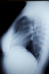 Chest Xray - Lateral  View