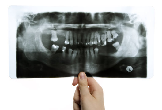 Roentgen photo of teeth