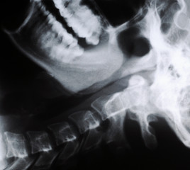 radiograph of human neck © Fotokon