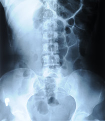 radiograph of human backbone