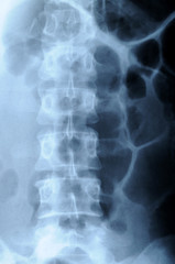 radiograph of human backbone