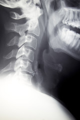 Cervical Spine - Lateral C-spine Xray