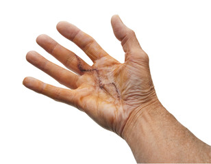 Male hand after surgery for Dupuytren's disease, isolated