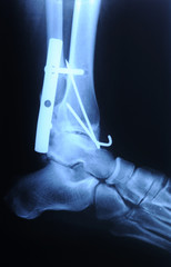radiograph of human fracture ankle