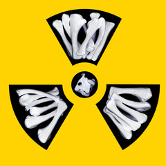 Radioactive bones
