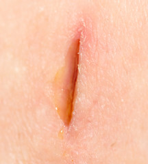 Incised abscess of foot