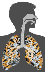 smoker's lung