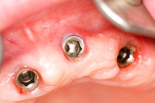 A macro shot of dental implants in the oral cavity