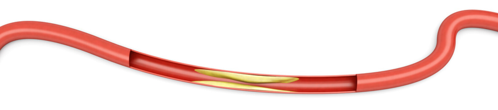 Arteriosklerose