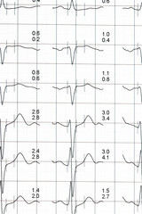 graphiques d'électrocardiogramme