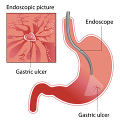 gastric  ulcer