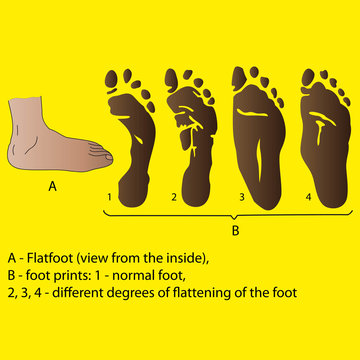 flatfoot