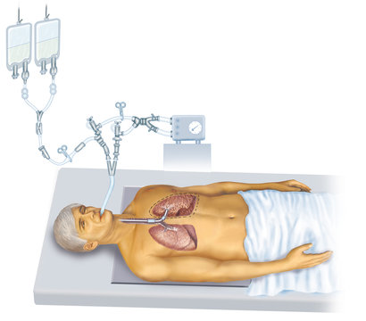 Lavado pulmonar