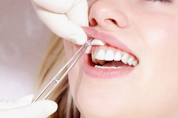 Frauenmund Zahnreinigung und Watterollen closeup
