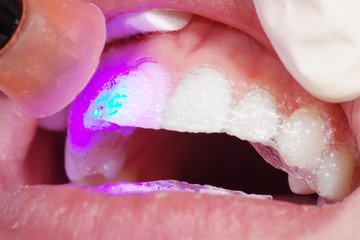 Kosmetische Zahnreinigung UV Bestrahlung  Nahaufnahme