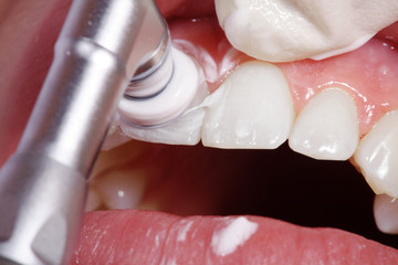 Zahnreinigung mit Polierer und Paste Nahaufnahme