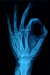 rentgen dłoń - obrazy, fototapety, plakaty