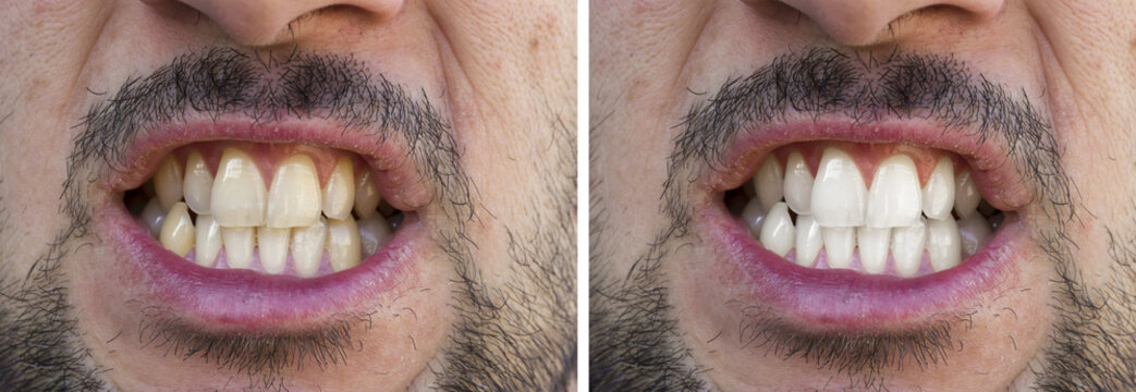 Prima e dopo lo sbiancamento dei denti