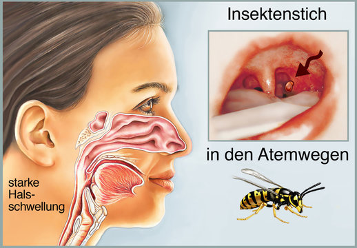 Insektenstich in den Atemwegen