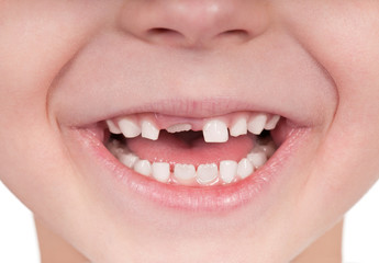 Toothless smile