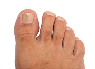A toenail infected with a fungus