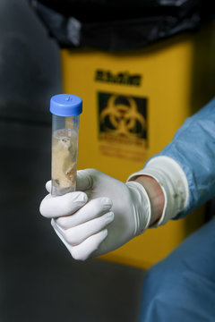 Scientist Holds A Brain Sample Of Mad Cow Disease