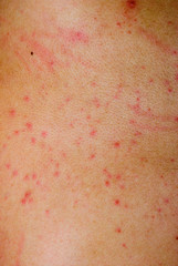 allergic rash dermatitis skin