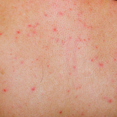 allergic rash dermatitis skin