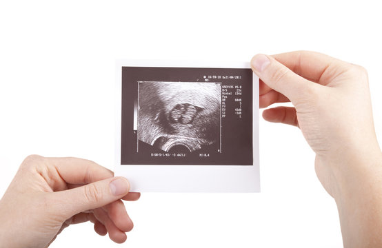 pregnant woman showing sonogram of Identical (monozygotic) twins