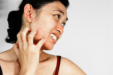 Woman scratch face with skin rash